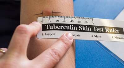  TB Test Made Easy: Free Mantoux Ruler for Accurate Skin Testing!